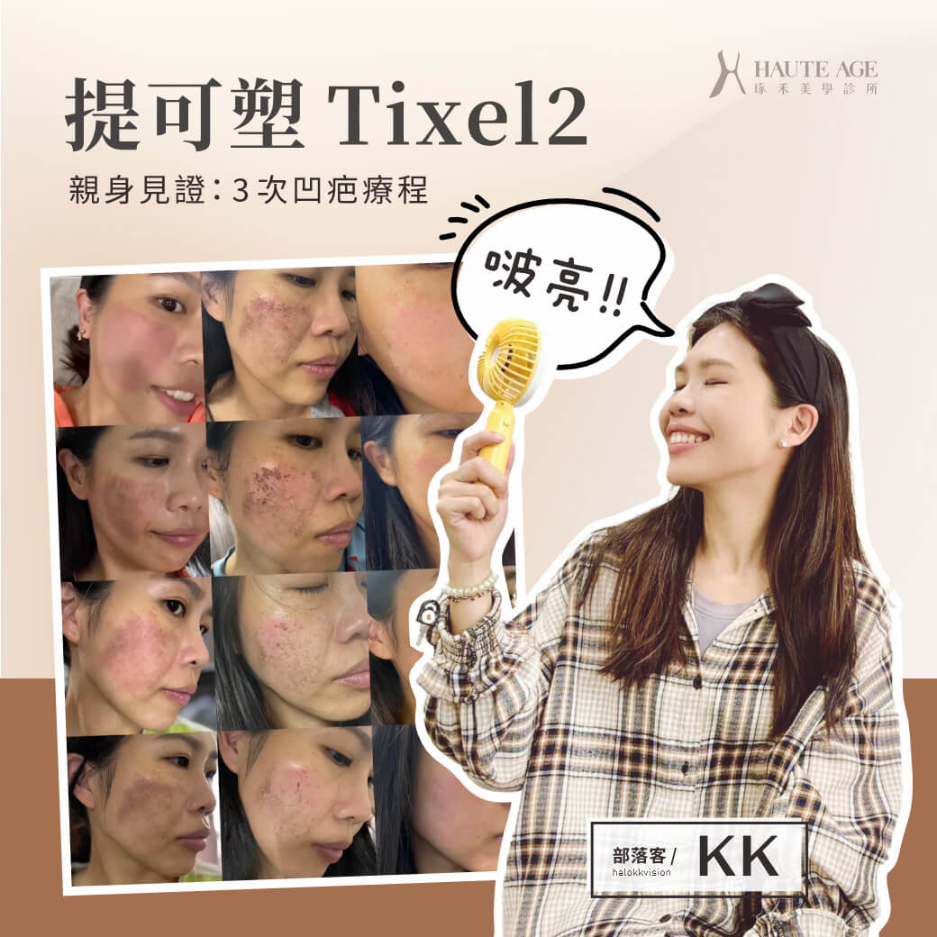 提可塑Tixel2｜親身見證：3次凹疤療程，膚質啵亮大升級-halokkvision-提可塑案例-琢禾美學診所-呂佩璇醫師-hauteage